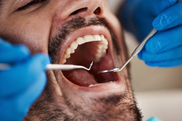 Best Emergency Root Canal Treatment in White Hall, IL